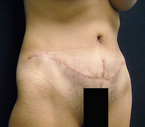 Chicago Tummy Tuck, Chicago Abdominoplasty